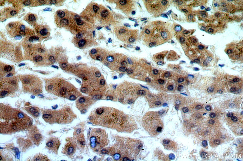 Immunohistochemistry (IHC) staining of human hepatocirrhosis tissue using ADAT2 Polyclonal antibody (13621-1-AP)