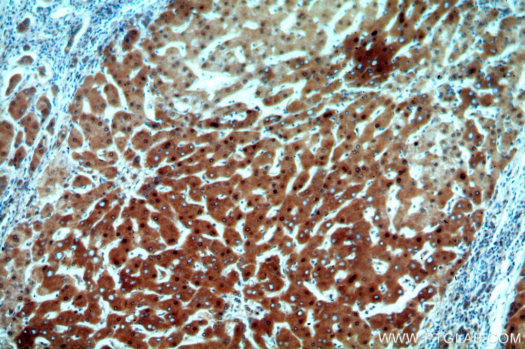 IHC staining of human hepatocirrhosis using 13621-1-AP