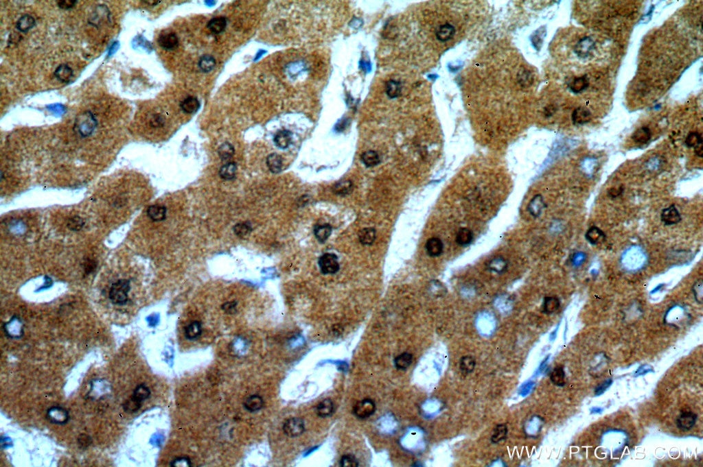 Immunohistochemistry (IHC) staining of human hepatocirrhosis tissue using ADAT2 Polyclonal antibody (13621-1-AP)