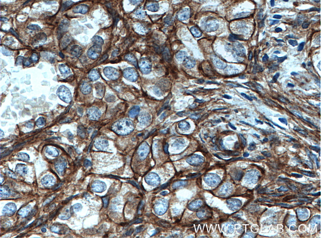 Immunohistochemistry (IHC) staining of human ovary tumor tissue using Alpha Adducin Polyclonal antibody (10791-1-AP)