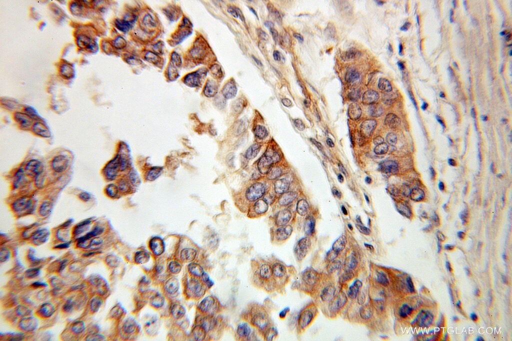 Immunohistochemistry (IHC) staining of human ovary tumor tissue using Alpha Adducin Polyclonal antibody (10791-1-AP)