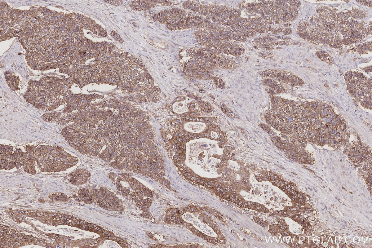 Immunohistochemistry (IHC) staining of human stomach cancer tissue using Gamma Adducin Polyclonal antibody (17585-1-AP)