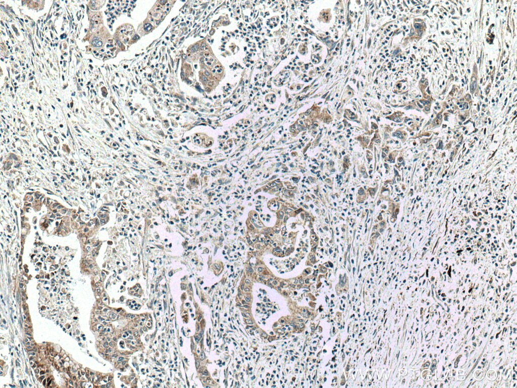 IHC staining of human pancreas cancer using 17165-1-AP