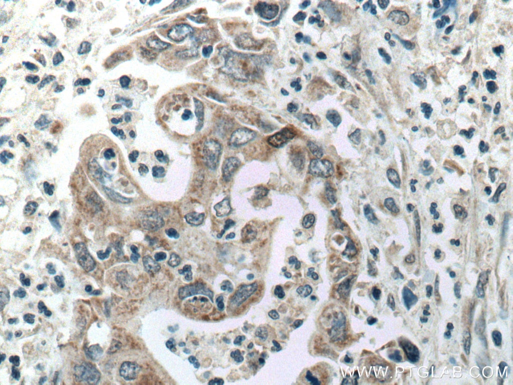 Immunohistochemistry (IHC) staining of human pancreas cancer tissue using ADH1B Polyclonal antibody (17165-1-AP)