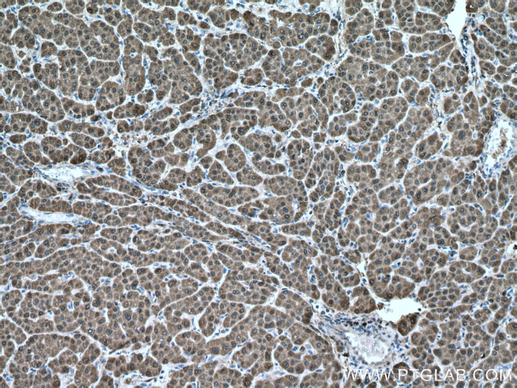 Immunohistochemistry (IHC) staining of human liver cancer tissue using ADH1B Monoclonal antibody (66939-1-Ig)