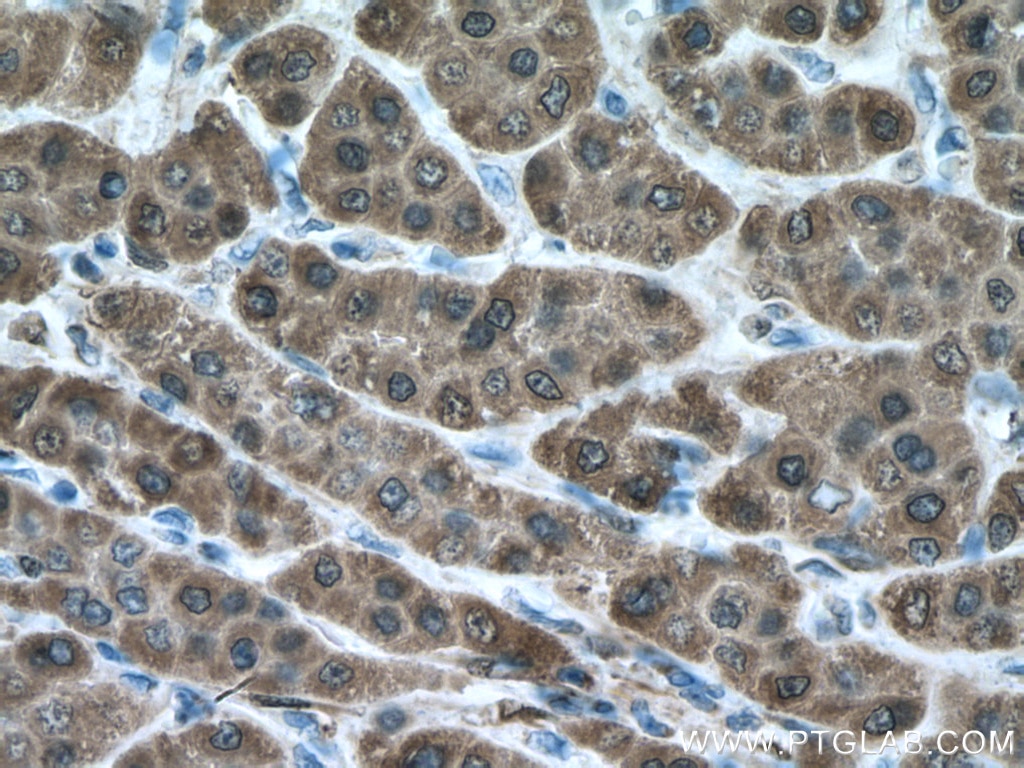 Immunohistochemistry (IHC) staining of human liver cancer tissue using ADH1B Monoclonal antibody (66939-1-Ig)