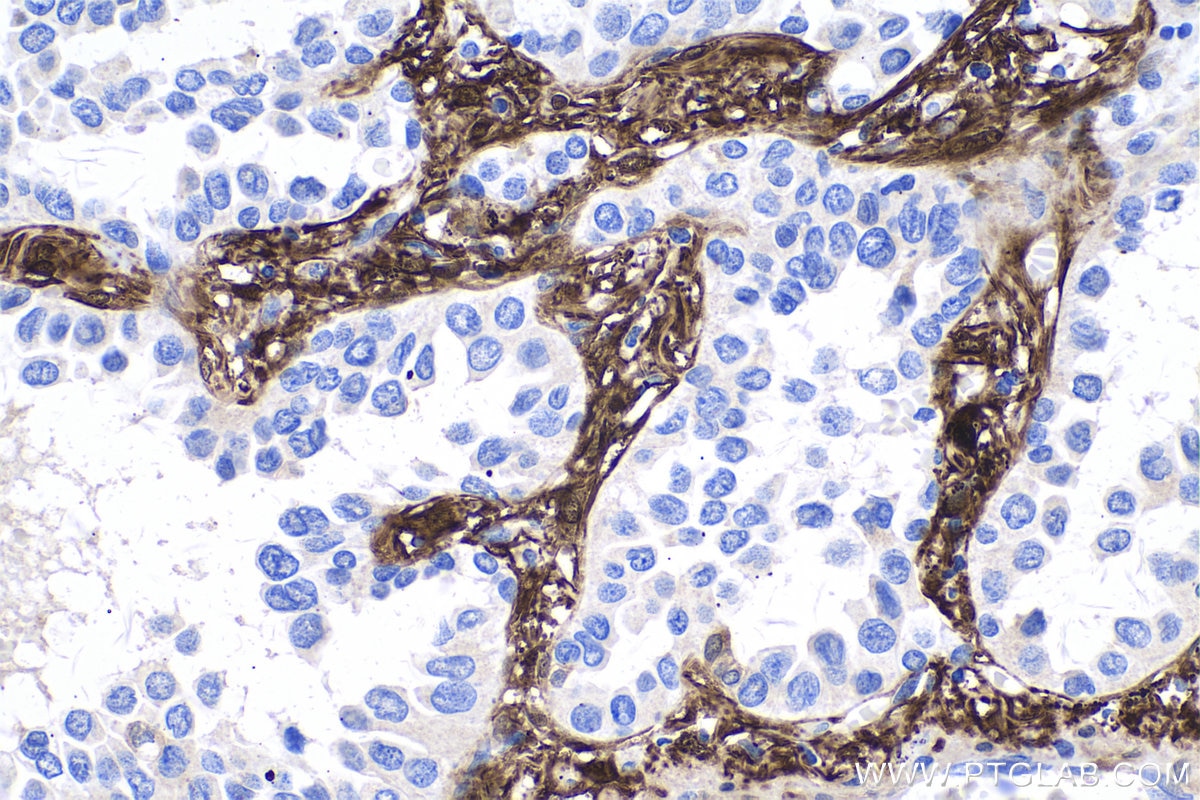 Immunohistochemistry (IHC) staining of human lung cancer tissue using ADH1C Polyclonal antibody (18897-1-AP)