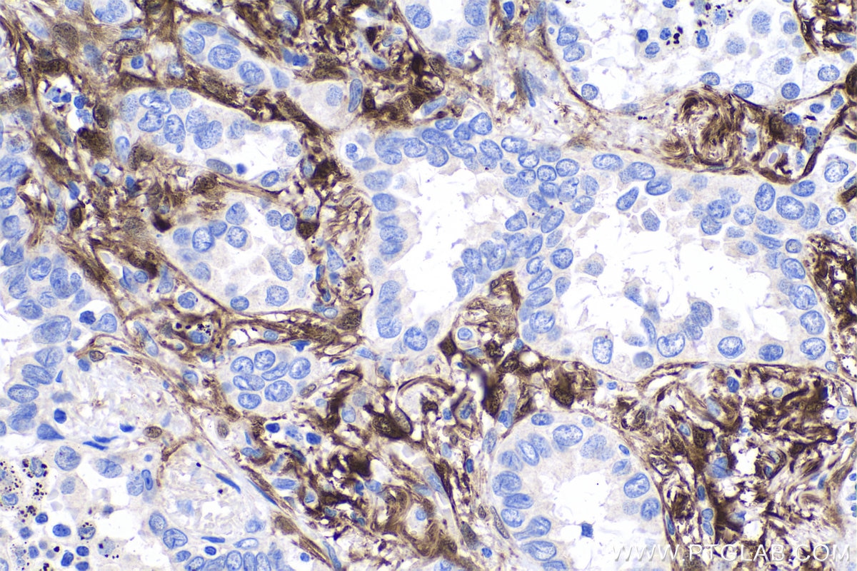 IHC staining of human lung cancer using 18897-1-AP