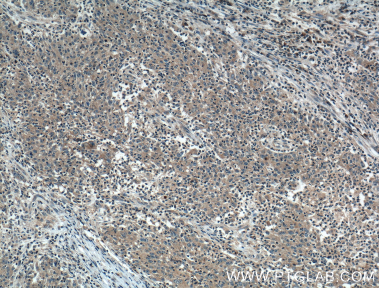 IHC staining of human colon cancer using 14674-1-AP