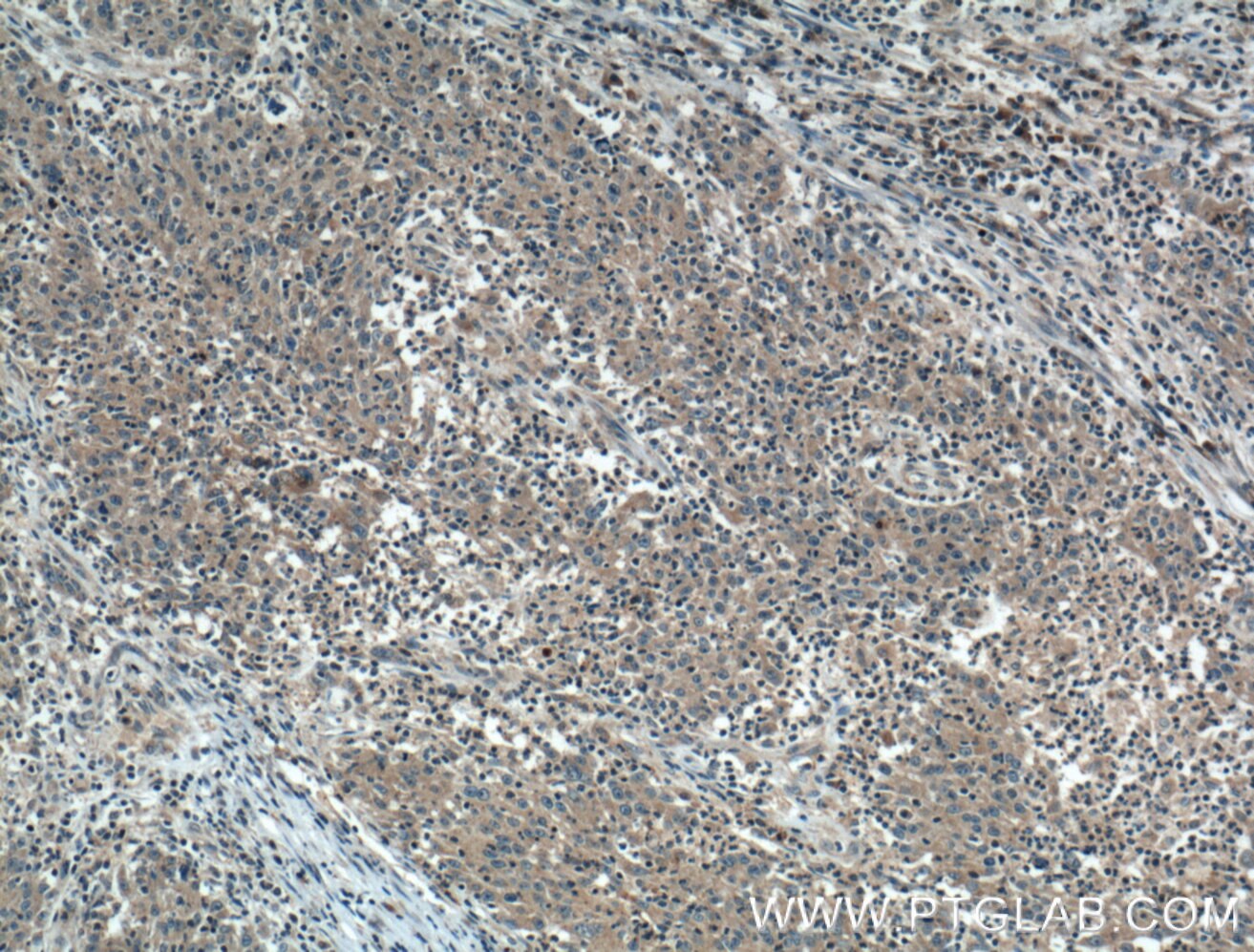 Immunohistochemistry (IHC) staining of human colon cancer tissue using ADHFE1 Polyclonal antibody (14674-1-AP)