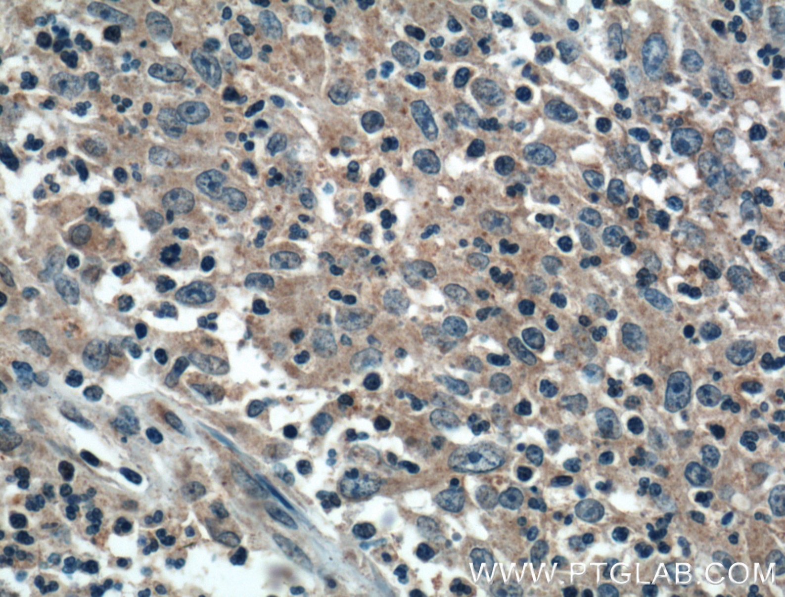 Immunohistochemistry (IHC) staining of human colon cancer tissue using ADHFE1 Polyclonal antibody (14674-1-AP)