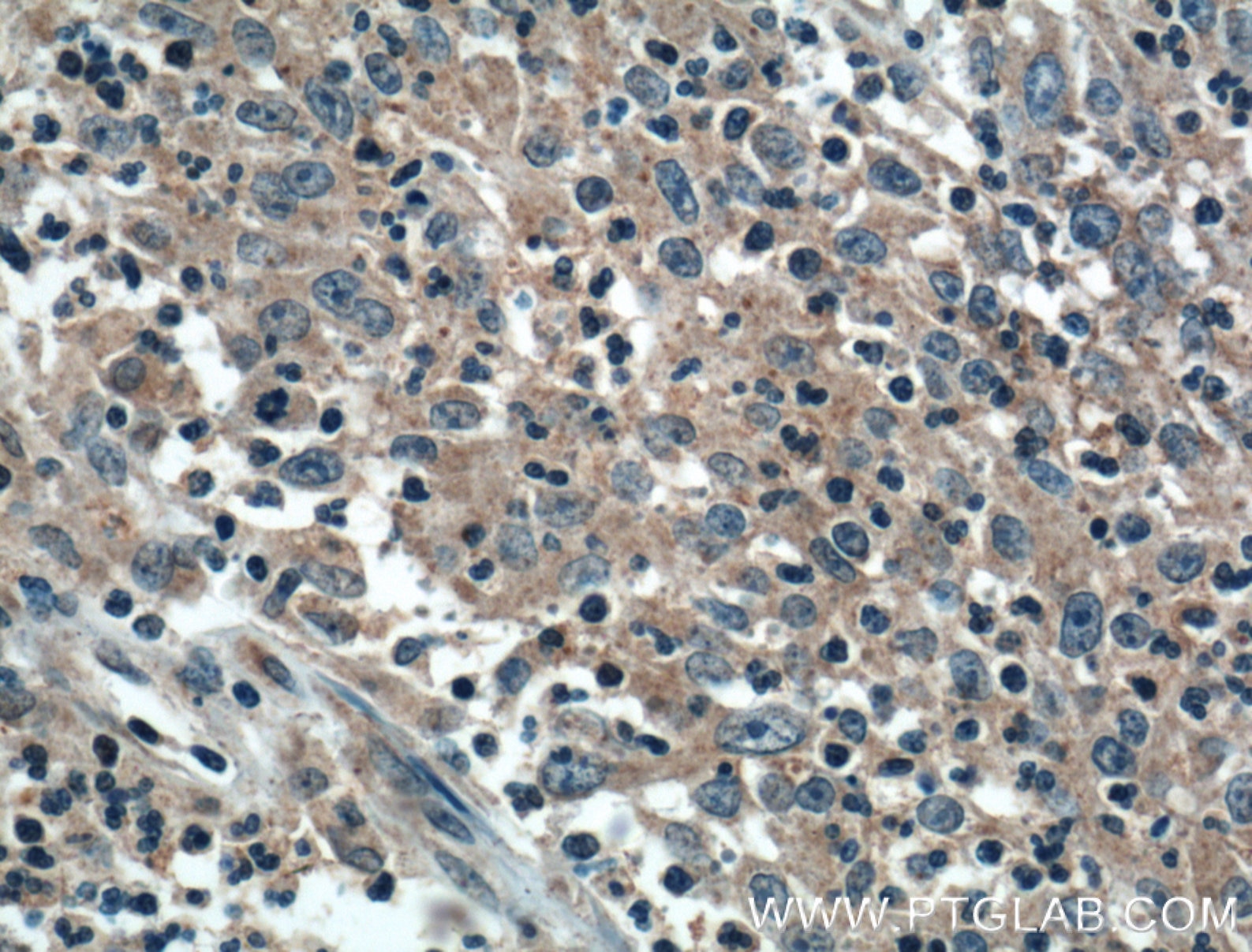 Immunohistochemistry (IHC) staining of human colon cancer tissue using ADHFE1 Polyclonal antibody (14674-1-AP)