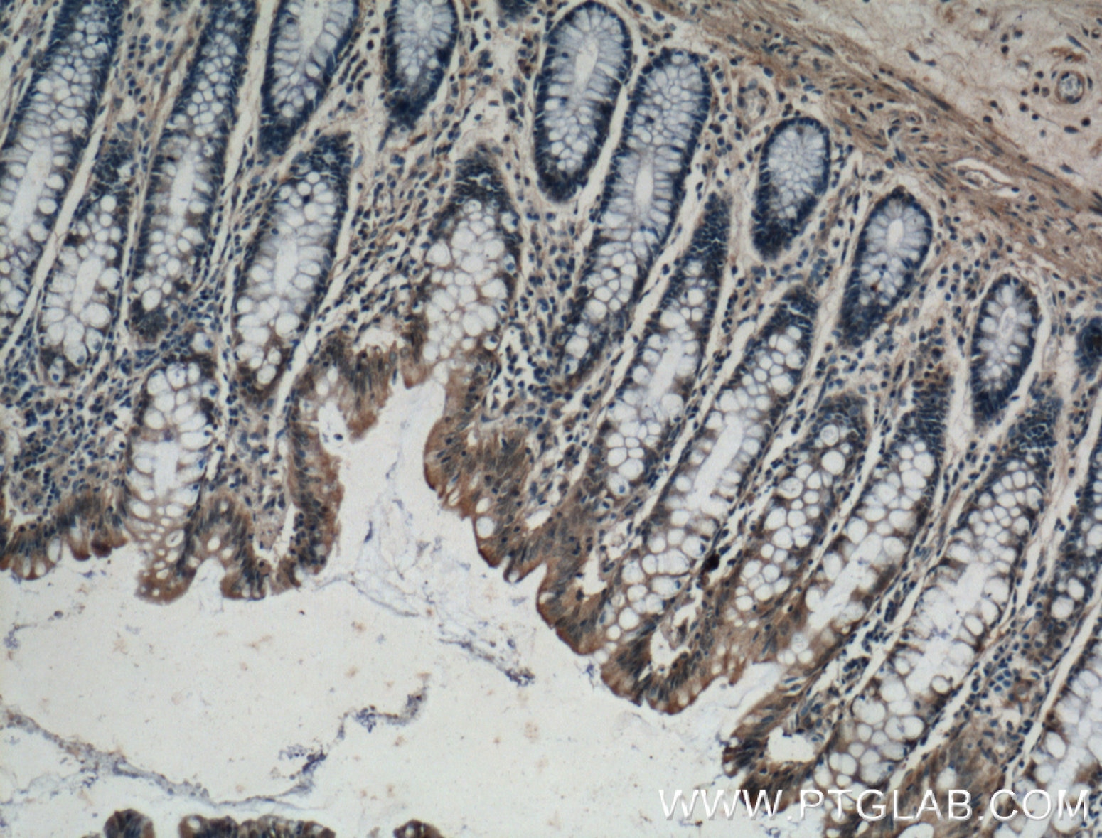 Immunohistochemistry (IHC) staining of human colon tissue using ADHFE1 Polyclonal antibody (14674-1-AP)