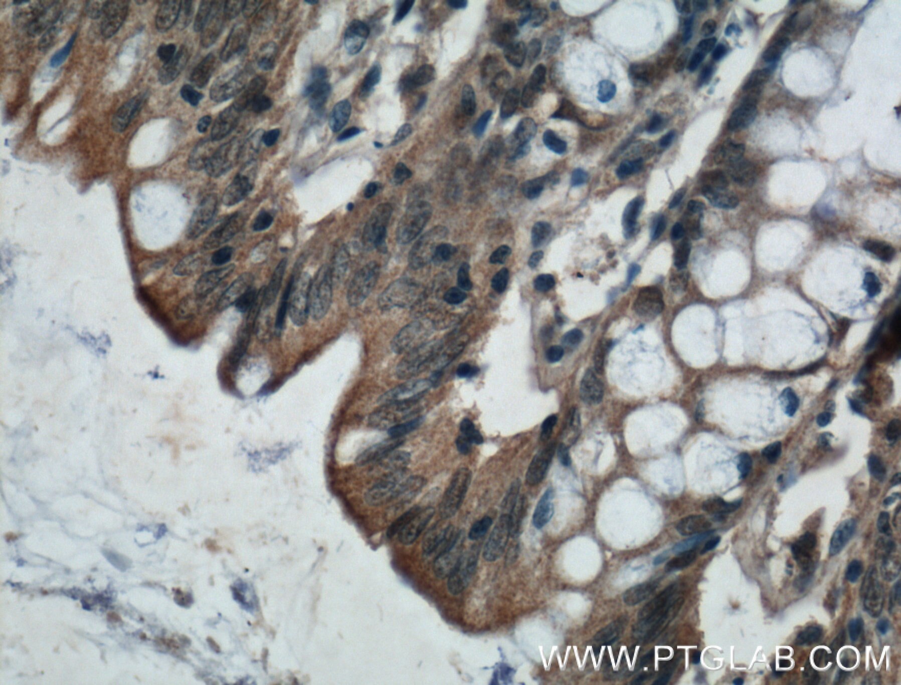 Immunohistochemistry (IHC) staining of human colon tissue using ADHFE1 Polyclonal antibody (14674-1-AP)