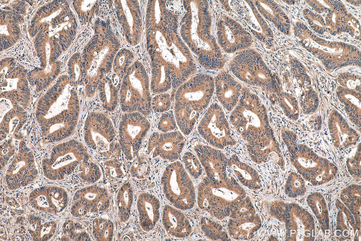 Immunohistochemistry (IHC) staining of human colon cancer tissue using ADHFE1 Polyclonal antibody (19359-1-AP)