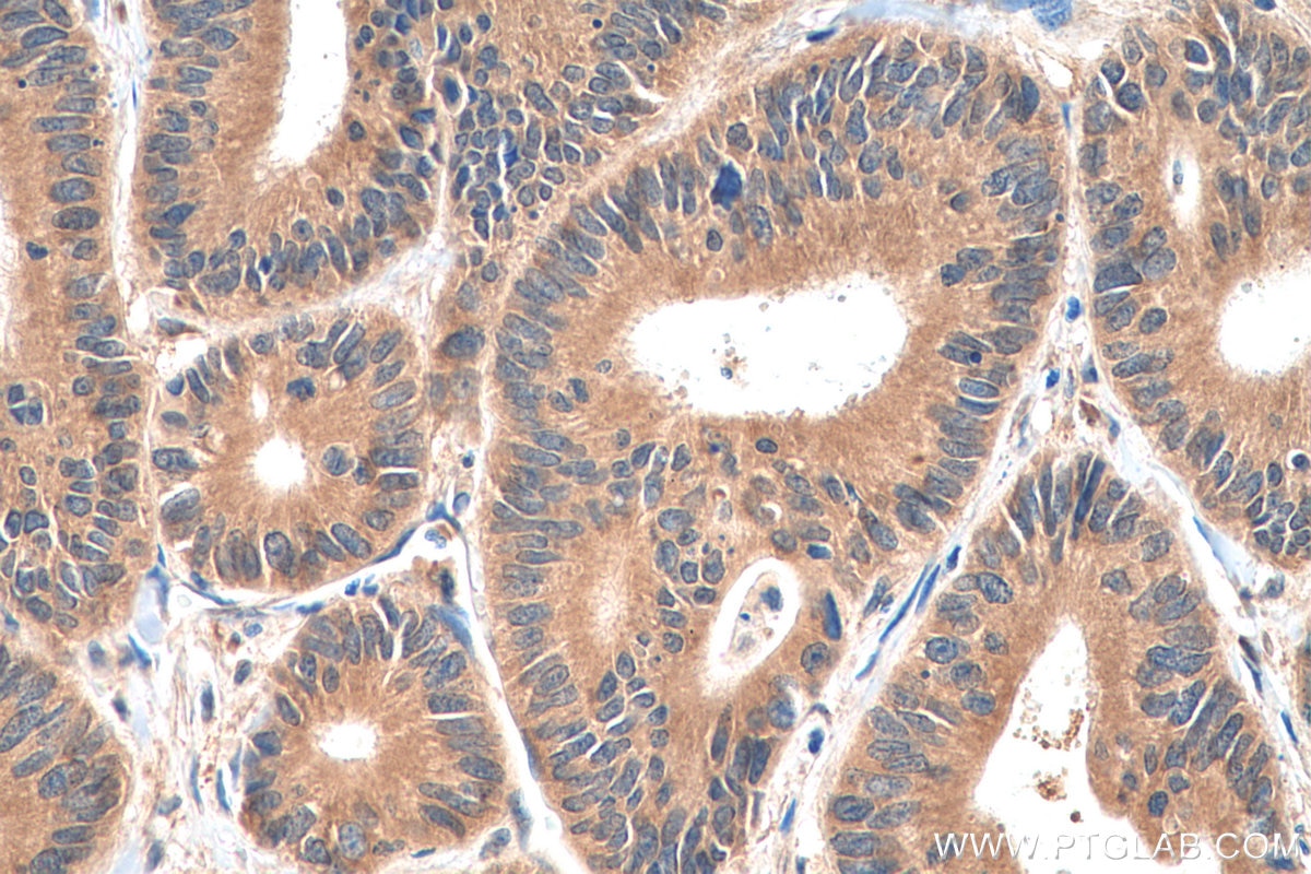 Immunohistochemistry (IHC) staining of human colon cancer tissue using ADHFE1 Polyclonal antibody (19359-1-AP)