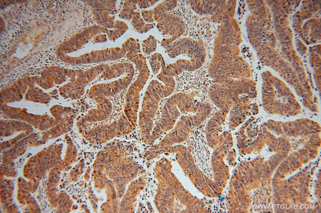 Immunohistochemistry (IHC) staining of human colon cancer tissue using ADI1 Polyclonal antibody (15133-1-AP)