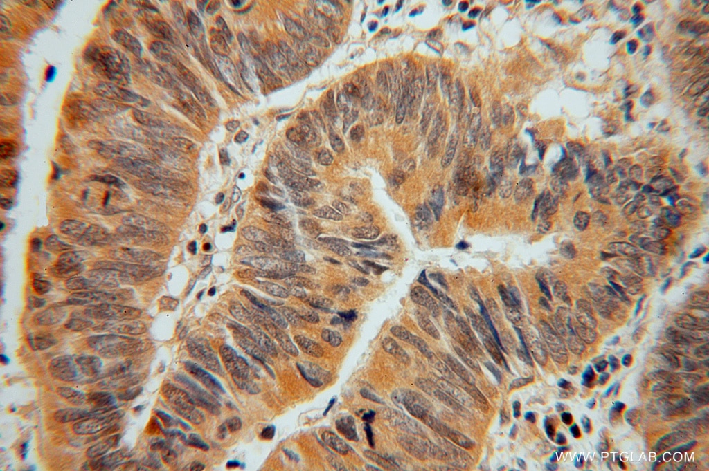 Immunohistochemistry (IHC) staining of human colon cancer tissue using ADI1 Polyclonal antibody (15133-1-AP)