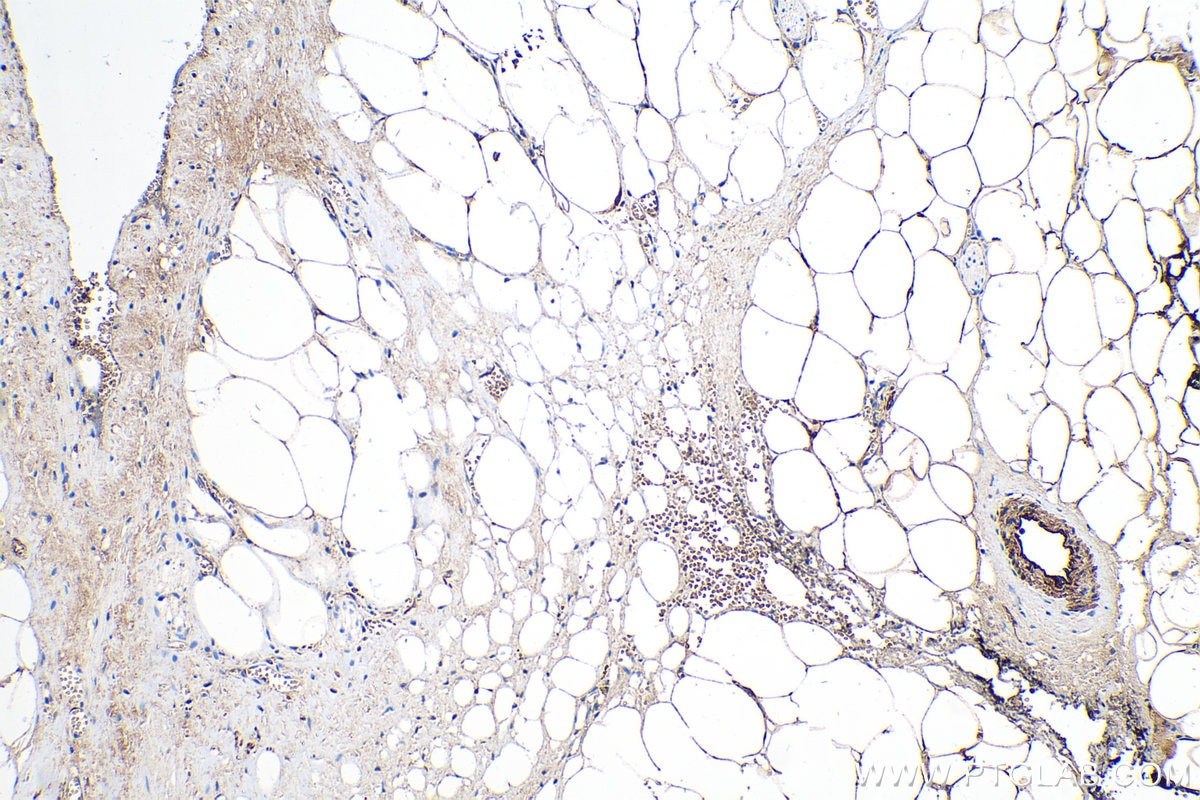 Immunohistochemistry (IHC) staining of human prostate cancer tissue using Adiponectin Polyclonal antibody (21613-1-AP)
