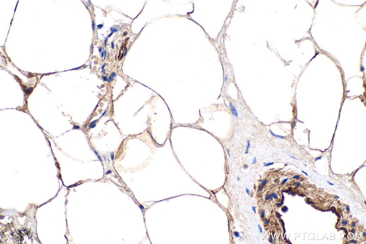 Immunohistochemistry (IHC) staining of human prostate cancer tissue using Adiponectin Polyclonal antibody (21613-1-AP)