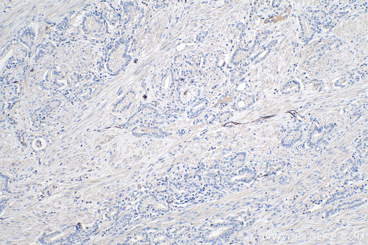 Immunohistochemistry (IHC) staining of human prostate cancer tissue using Adiponectin Monoclonal antibody (66239-1-Ig)