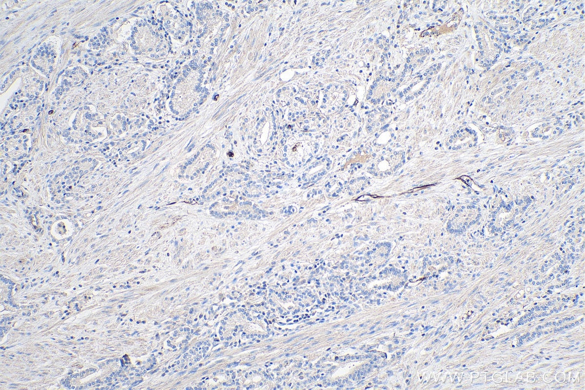 IHC staining of human prostate cancer using 66239-1-Ig