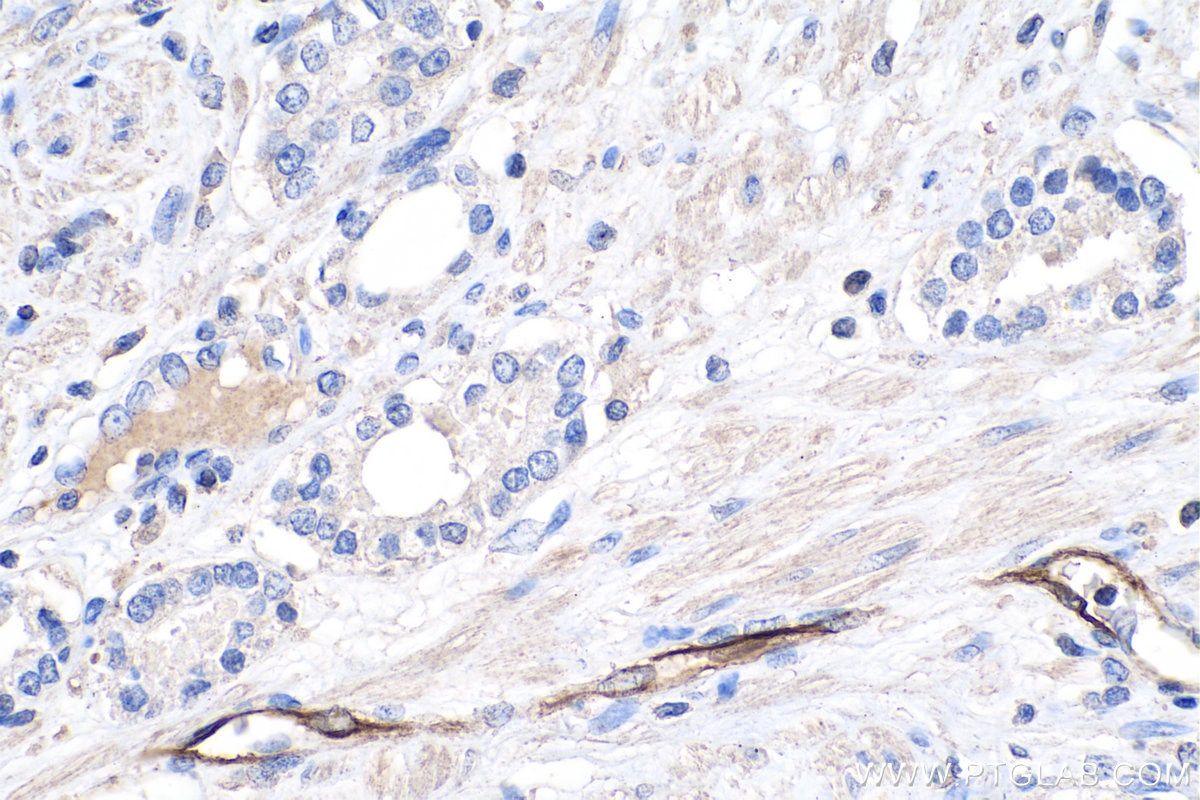 Immunohistochemistry (IHC) staining of human prostate cancer tissue using Adiponectin Monoclonal antibody (66239-1-Ig)