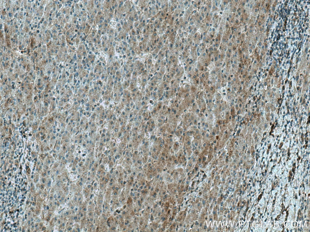 Immunohistochemistry (IHC) staining of human liver cancer tissue using ADK Polyclonal antibody (15477-1-AP)