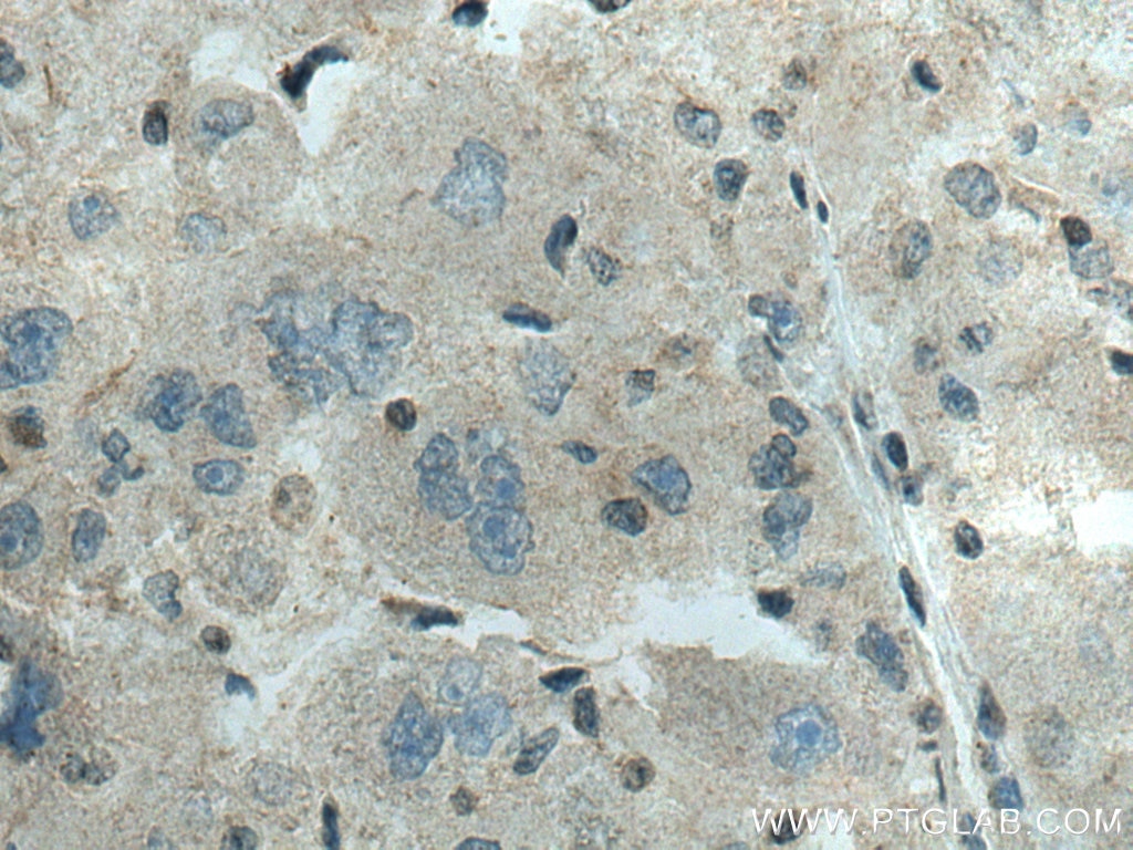 Immunohistochemistry (IHC) staining of human liver cancer tissue using ADK Polyclonal antibody (15477-1-AP)