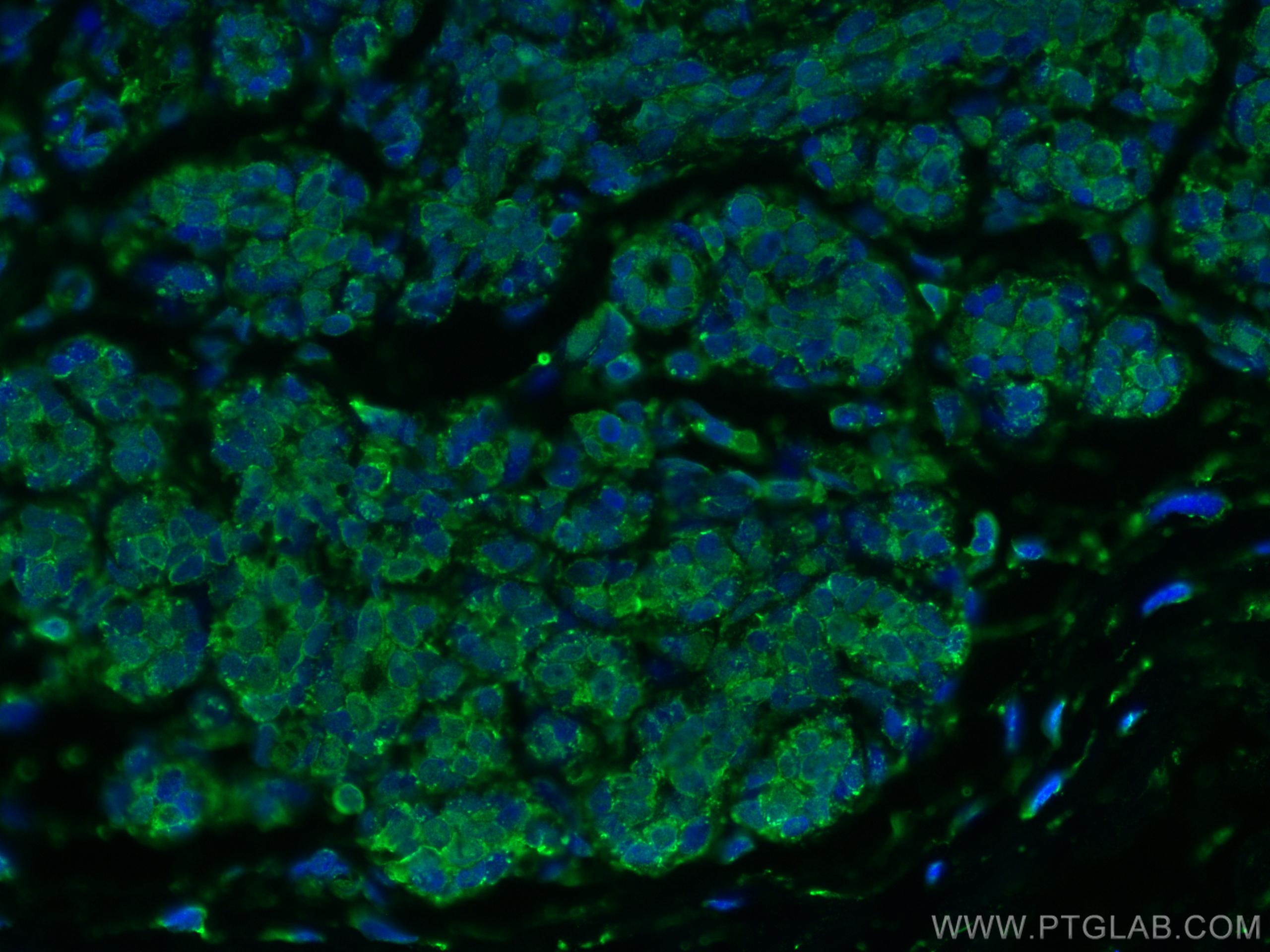 Immunofluorescence (IF) / fluorescent staining of human breast cancer tissue using ADK Monoclonal antibody (66929-1-Ig)