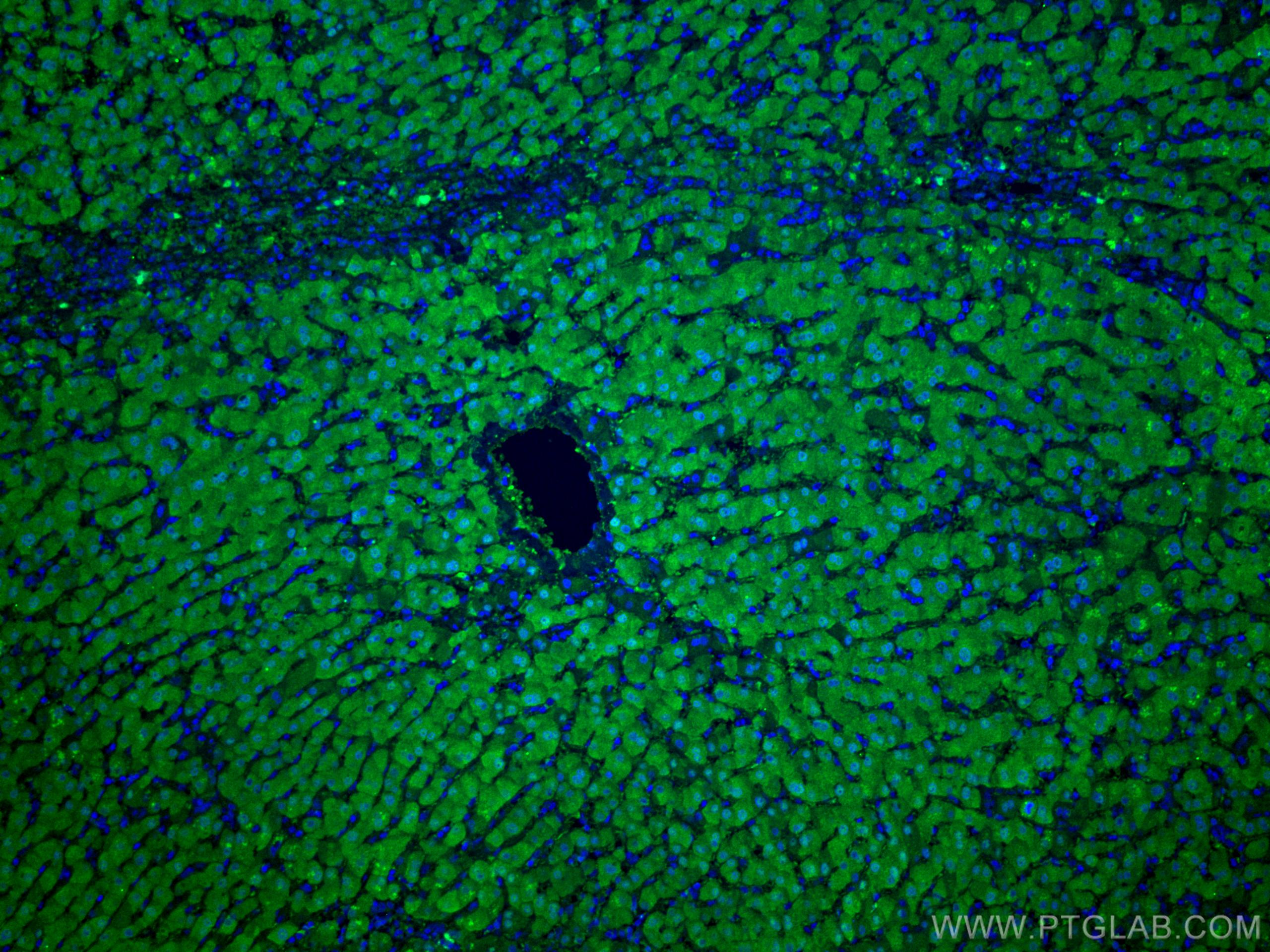 Immunofluorescence (IF) / fluorescent staining of human liver cancer tissue using ADK Monoclonal antibody (66929-1-Ig)