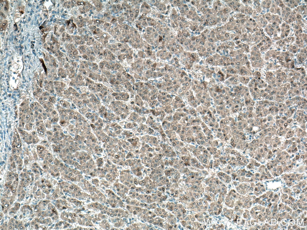 Immunohistochemistry (IHC) staining of human liver cancer tissue using ADK Monoclonal antibody (66929-1-Ig)