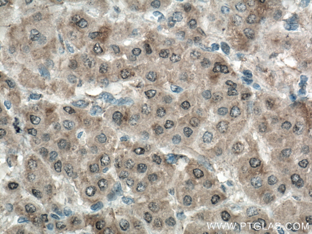 IHC staining of human liver cancer using 66929-1-Ig