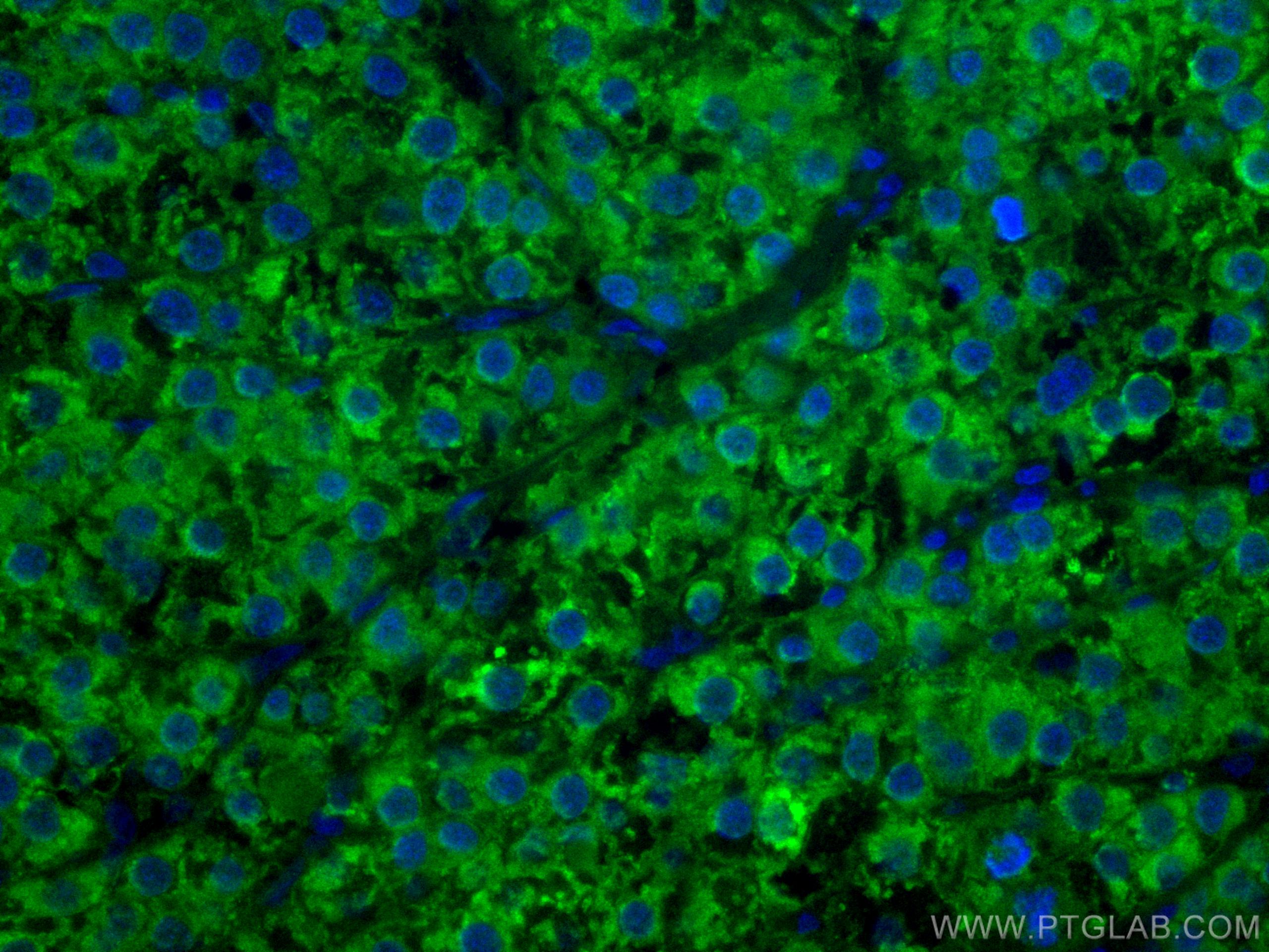 Immunofluorescence (IF) / fluorescent staining of human liver cancer tissue using CoraLite® Plus 488-conjugated ADK Monoclonal antib (CL488-66929)