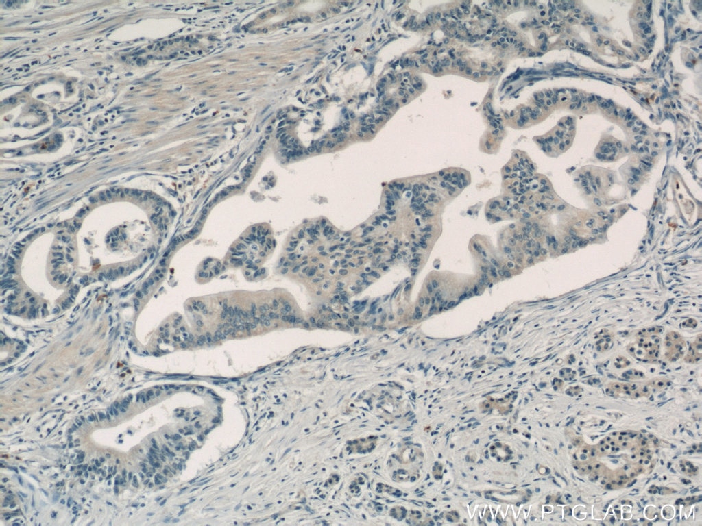 Immunohistochemistry (IHC) staining of human pancreas cancer tissue using Adrenomedullin Polyclonal antibody (10778-1-AP)