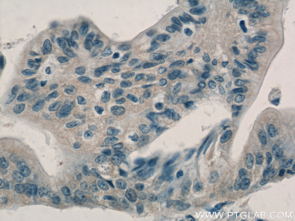 Immunohistochemistry (IHC) staining of human pancreas cancer tissue using Adrenomedullin Polyclonal antibody (10778-1-AP)