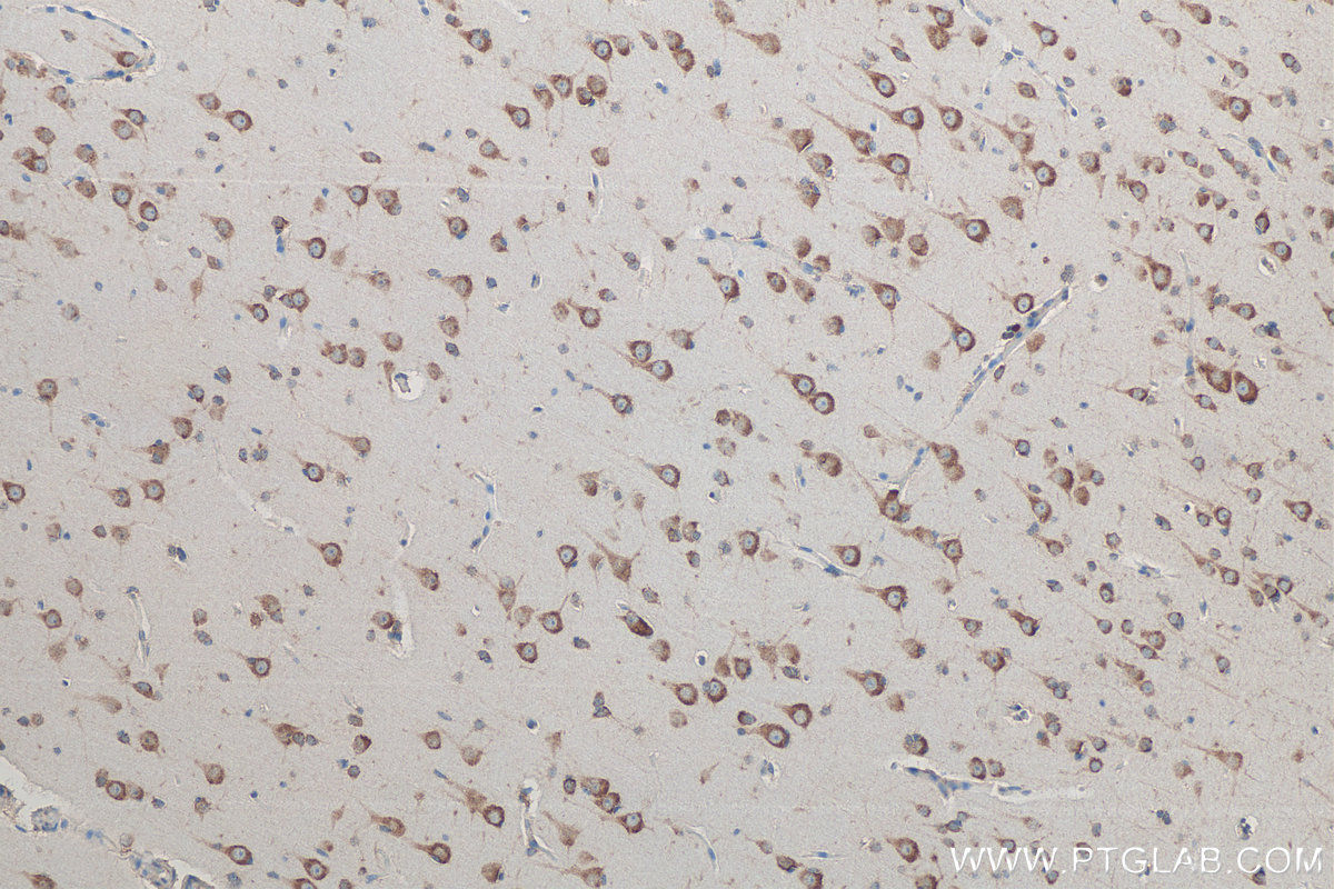 Immunohistochemistry (IHC) staining of human gliomas tissue using ADRA2B-Specific Polyclonal antibody (19778-1-AP)