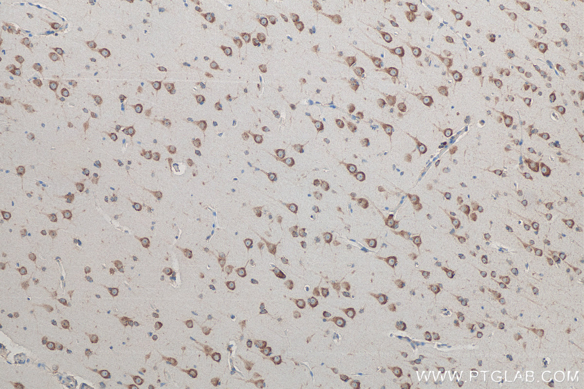 IHC staining of human gliomas using 19778-1-AP