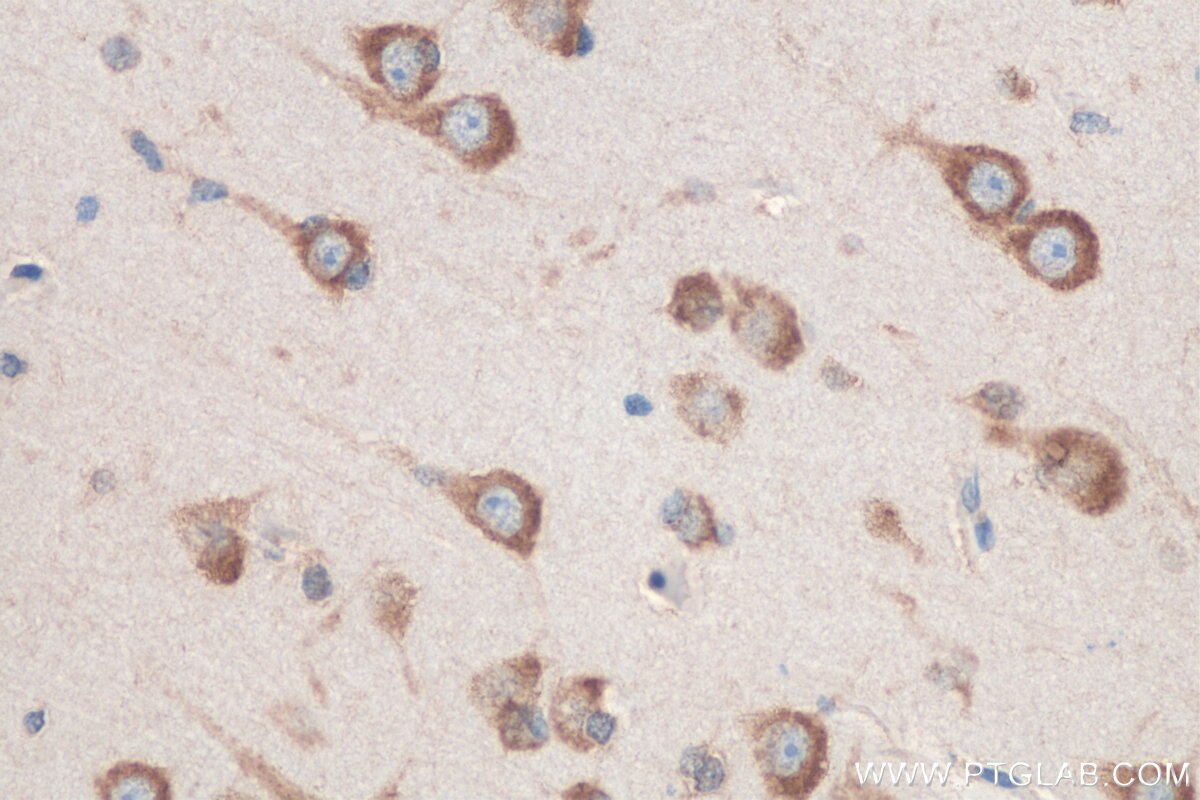 Immunohistochemistry (IHC) staining of human gliomas tissue using ADRA2B-Specific Polyclonal antibody (19778-1-AP)