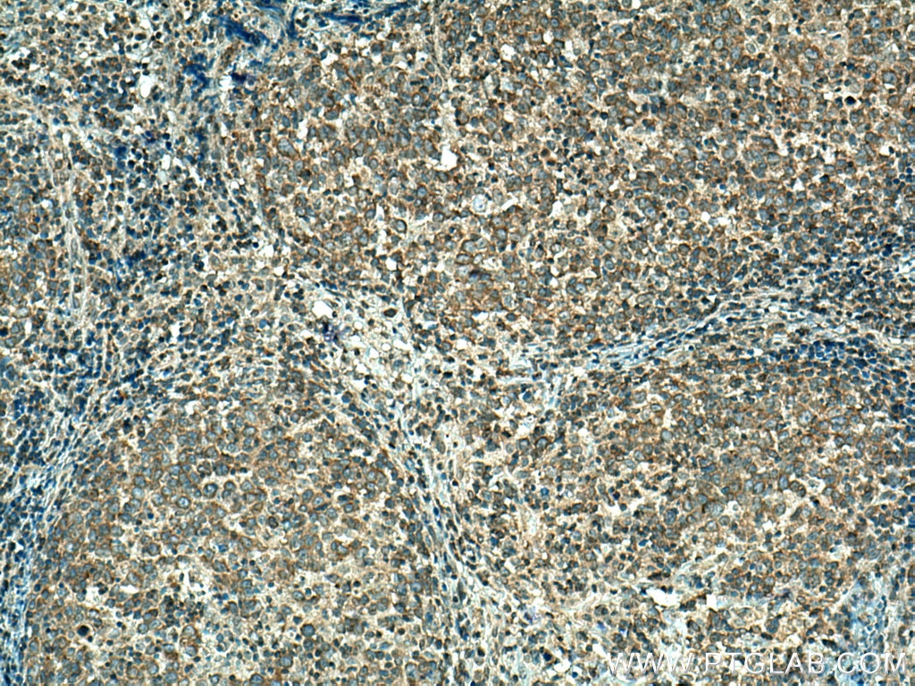 Immunohistochemistry (IHC) staining of human lymphoma tissue using GRK2 Polyclonal antibody (13990-1-AP)