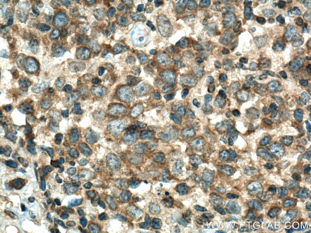 Immunohistochemistry (IHC) staining of human lymphoma tissue using GRK2 Polyclonal antibody (13990-1-AP)