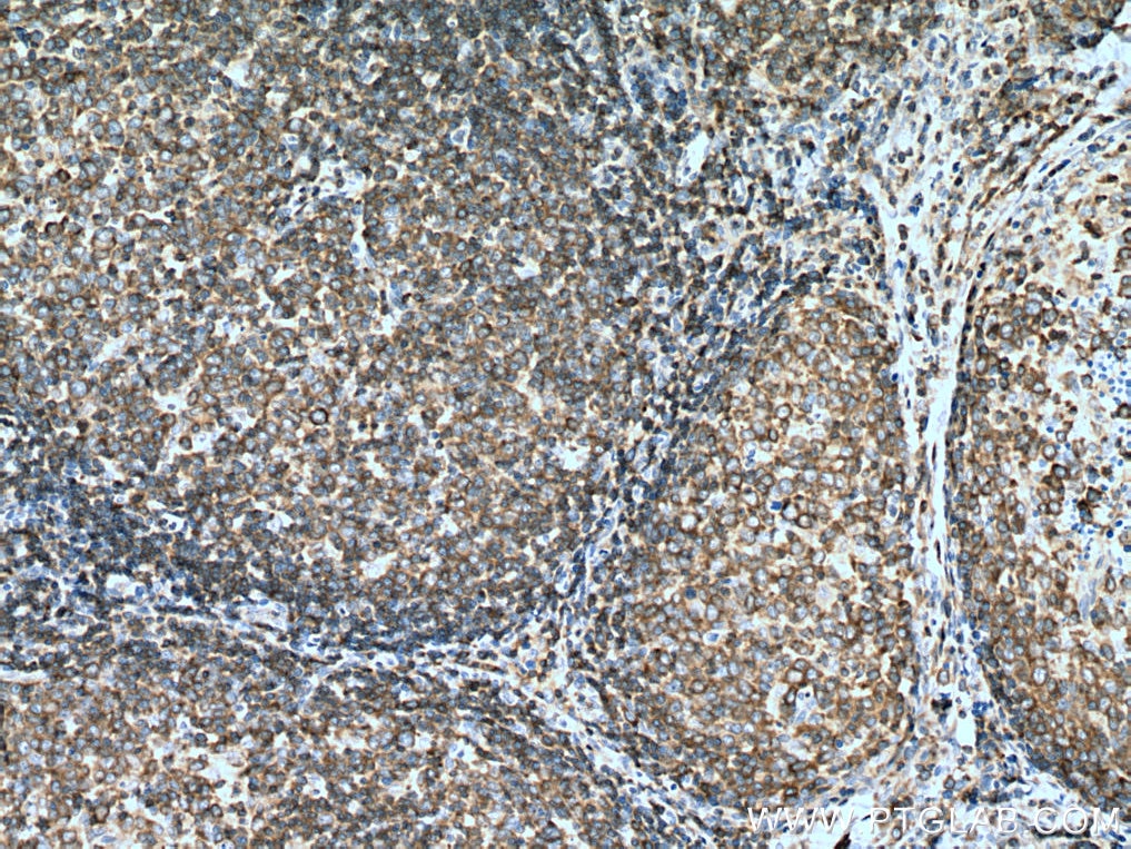 Immunohistochemistry (IHC) staining of human lymphoma tissue using ADRBK1 Monoclonal antibody (67067-1-Ig)