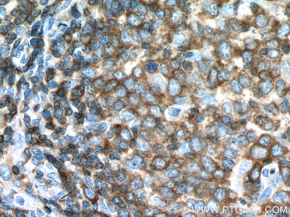 Immunohistochemistry (IHC) staining of human lymphoma tissue using ADRBK1 Monoclonal antibody (67067-1-Ig)