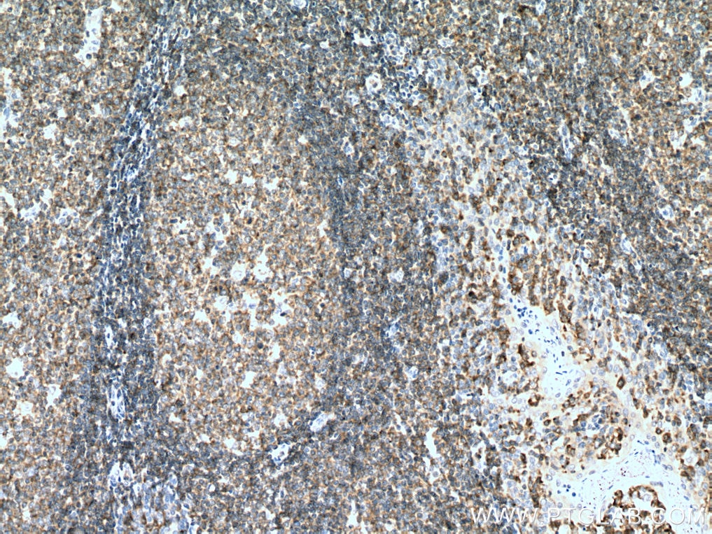 Immunohistochemistry (IHC) staining of human tonsillitis tissue using ADRBK1 Monoclonal antibody (67067-1-Ig)