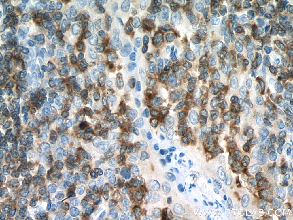 Immunohistochemistry (IHC) staining of human tonsillitis tissue using ADRBK1 Monoclonal antibody (67067-1-Ig)