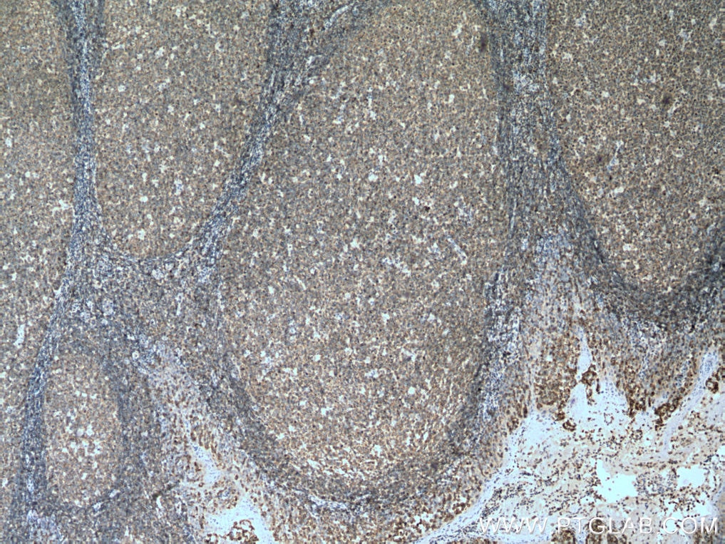 IHC staining of human tonsillitis using 67067-1-Ig