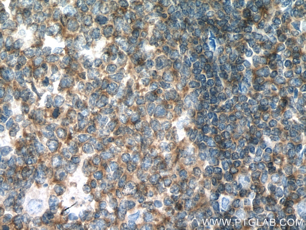 IHC staining of human tonsillitis using 67067-1-Ig