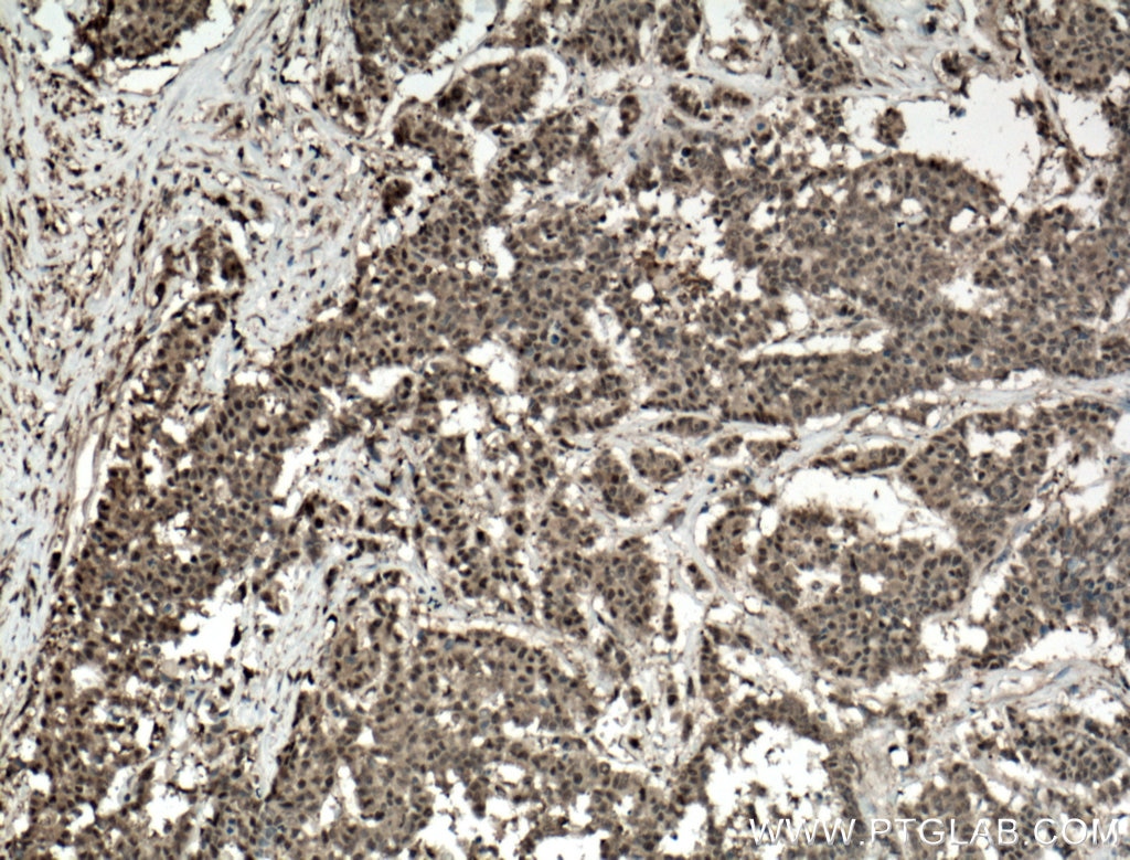 Immunohistochemistry (IHC) staining of human colon cancer tissue using ADRM1 Polyclonal antibody (11468-1-AP)