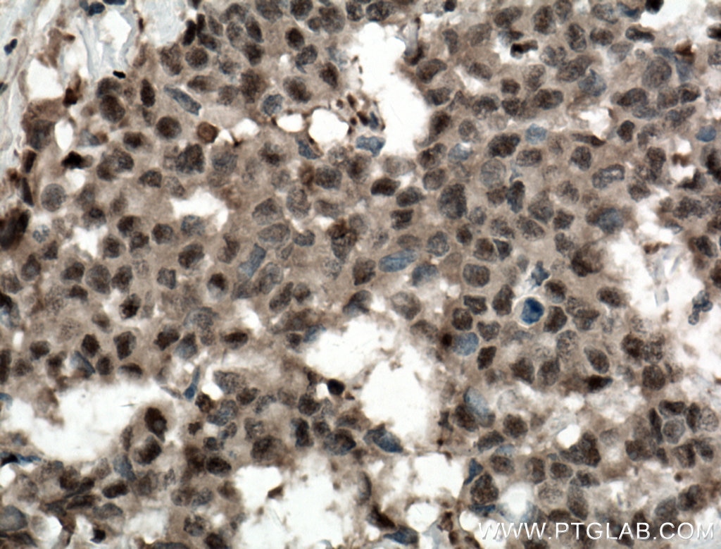 Immunohistochemistry (IHC) staining of human colon cancer tissue using ADRM1 Polyclonal antibody (11468-1-AP)