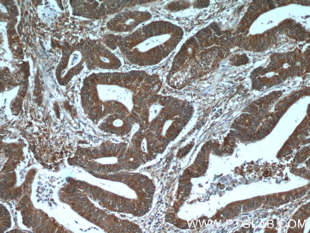 Immunohistochemistry (IHC) staining of human colon cancer tissue using ADRP/Perilipin 2 Polyclonal antibody (15294-1-AP)